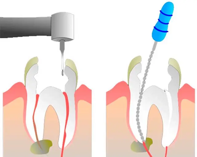 Endodontia em Blumenau - Odonto Compass