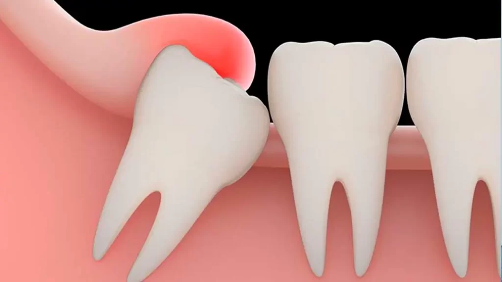 Sisos Impactados - Benefícios e Importância da Extração - Odonto Compass Odontologia Blumenau